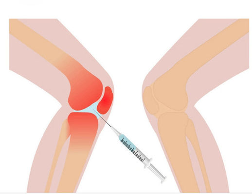 3ml Διάλυμα Μεσοθεραπείας Πόνος Γόνατου Μη Διασταυρωμένο Υαλουρονικό Οξύ