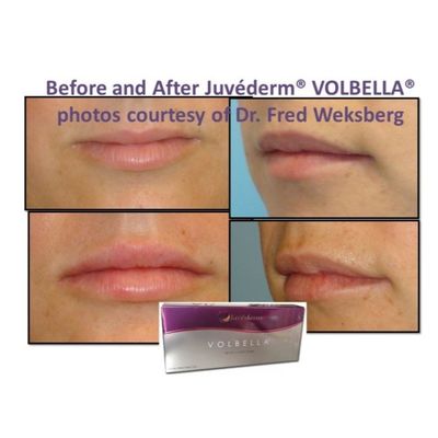 Υαλουρονικό οξύ Juvederm Gel Γεμιστήρας Προσώπου