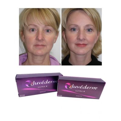 6-9 μήνες διάρκεια Juvederm Dermal Filler Gel για αγορά στο διαδίκτυο και στο κατάστημα