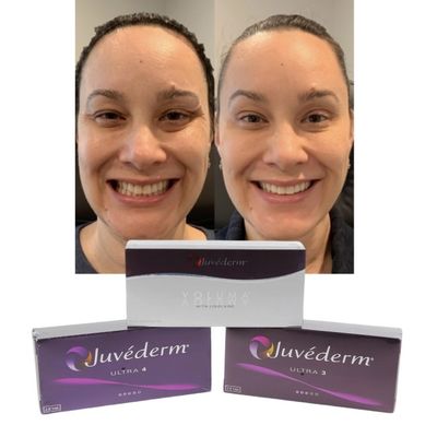 Το Juvederm Dermal Lip Fillers Hyaluronic Acid Cross Linked Injection (Τζουβέντερμ Δερματικά Σφραγίσματα για το Λιπάκι)