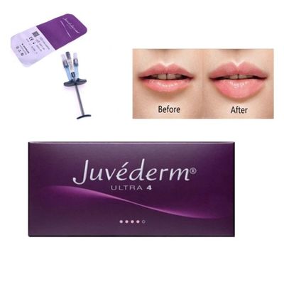 Allergan Juvederm Dermal Filler Injection Ultra4 με Λίντο