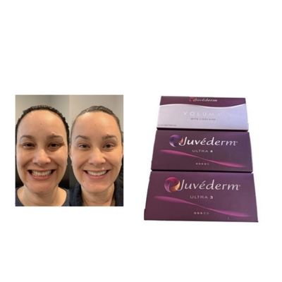 Ενέσιμη Juvederm Voluma Cross Linked Dermal Filler (Περιβληματικό δερματικό γεμιστήρα)