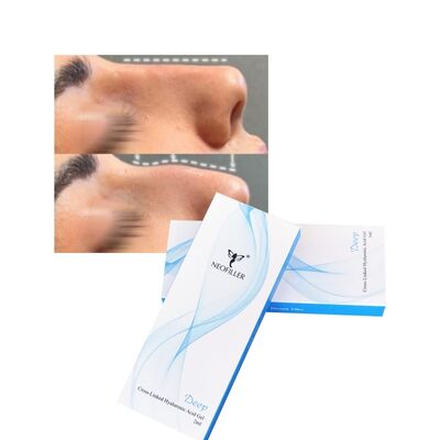 Δερματικό υλικό γεμίσματος Cross linked Deep Line Filler 2ml για ανύψωση μύτης