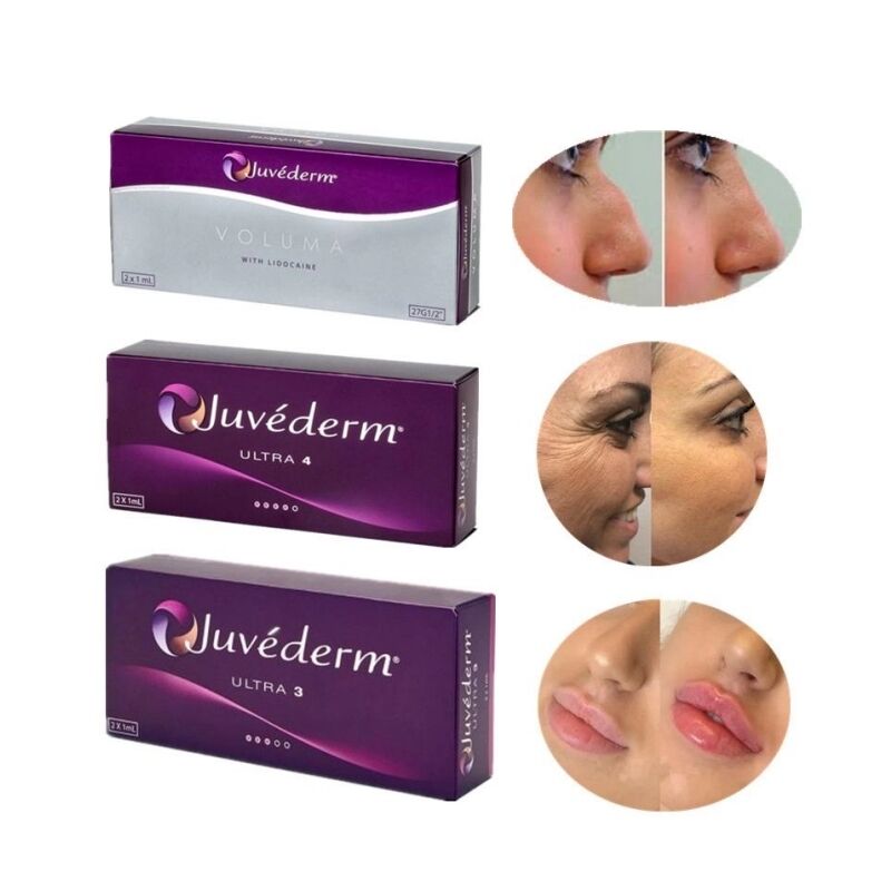 Διαφανές ενέσιμο δερματικό πληρωτικό για αύξηση χειλιών
