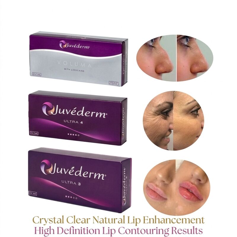 Όγκος της σύριγγας 2 1 ml ανά κουτί Juvederm Voluma Filler Ασφάλεια Προσωπική διαμόρφωση Ενέσιμη δερματική γέμιση για αύξηση του όγκου